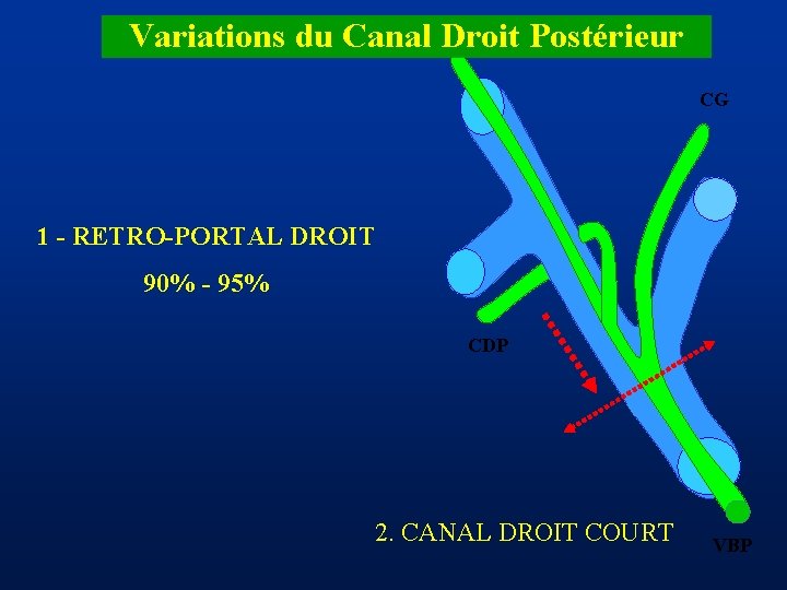 Variations du Canal Droit Postérieur CDA CG 1 - RETRO-PORTAL DROIT 90% - 95%