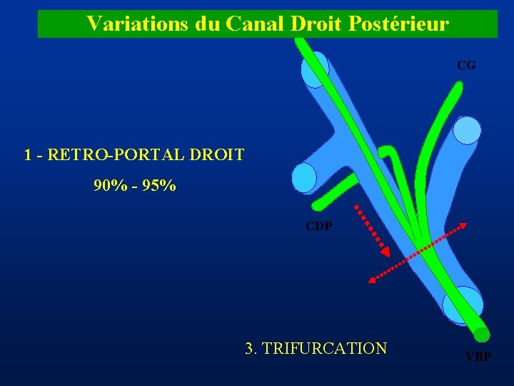 Variations du Canal Droit Postérieur CDA CG 1 - RETRO-PORTAL DROIT 90% - 95%
