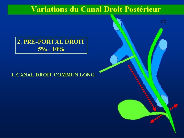 Variations du Canal Droit Postérieur CG 2. PRE-PORTAL DROIT 5% - 10% 1. CANAL