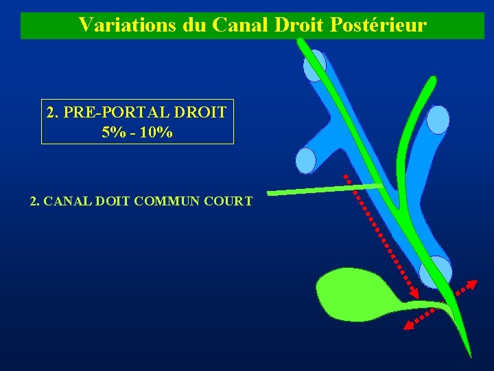 Variations du Canal Droit Postérieur 2. PRE-PORTAL DROIT 5% - 10% 2. CANAL DOIT