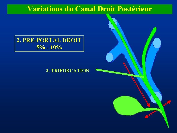 Variations du Canal Droit Postérieur 2. PRE-PORTAL DROIT 5% - 10% 3. TRIFURCATION 