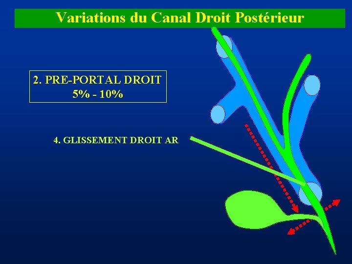 Variations du Canal Droit Postérieur 2. PRE-PORTAL DROIT 5% - 10% 4. GLISSEMENT DROIT