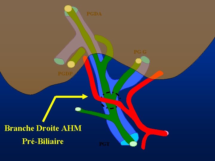 PGDA PG G PGDP Branche Droite AHM Pré-Biliaire PGT 