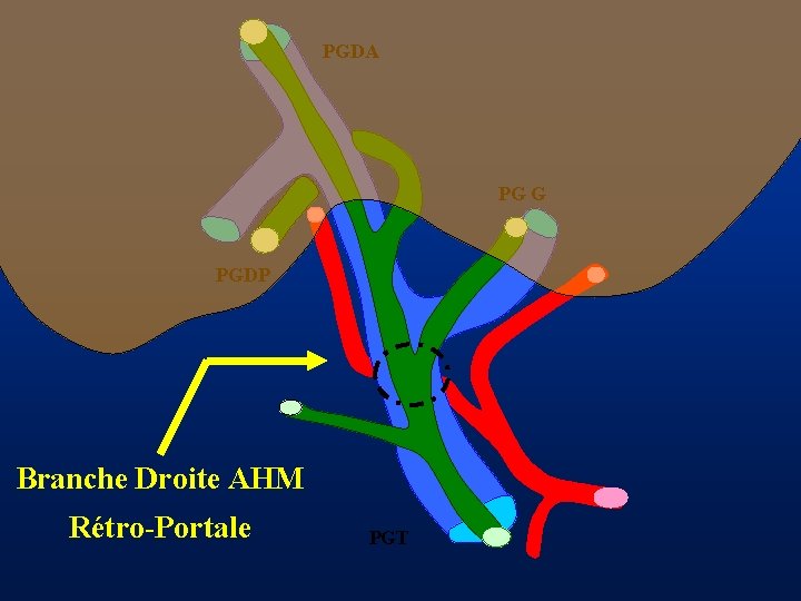 PGDA PG G PGDP Branche Droite AHM Rétro-Portale PGT 