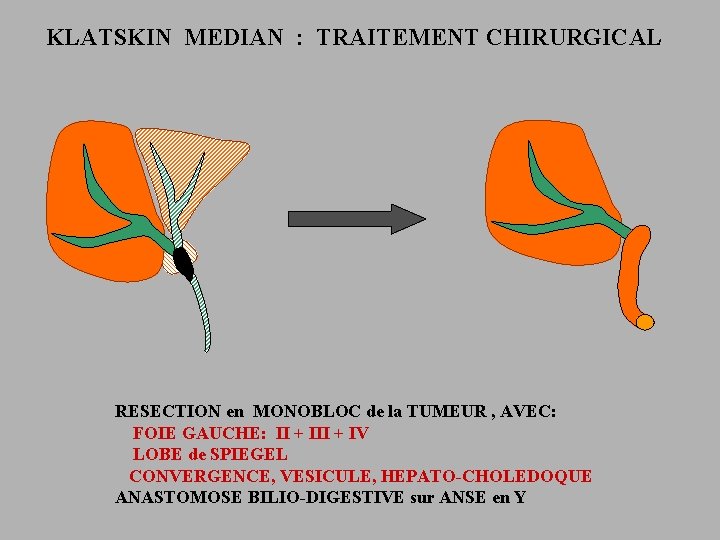 KLATSKIN MEDIAN : TRAITEMENT CHIRURGICAL RESECTION en MONOBLOC de la TUMEUR , AVEC: FOIE