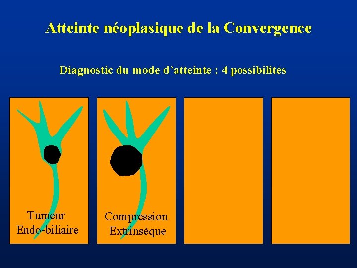 Atteinte néoplasique de la Convergence Diagnostic du mode d’atteinte : 4 possibilités Tumeur Endo-biliaire
