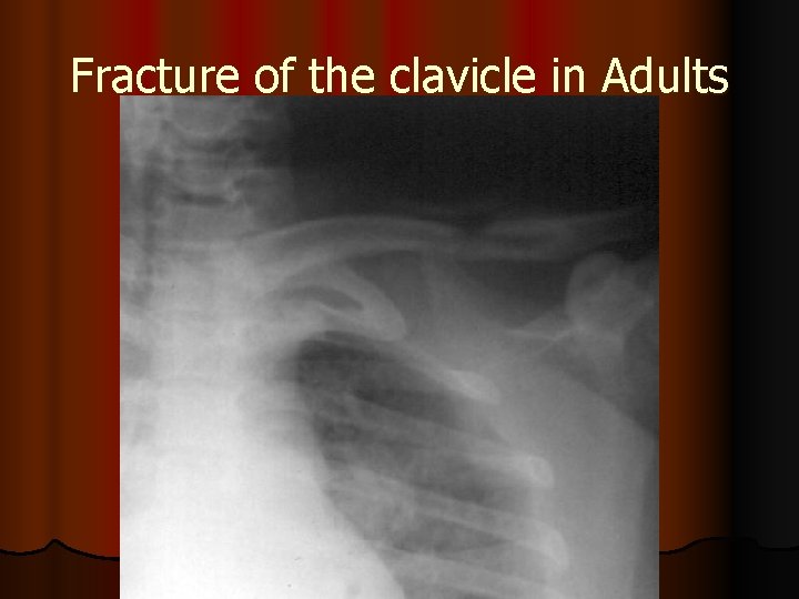 Fracture of the clavicle in Adults 