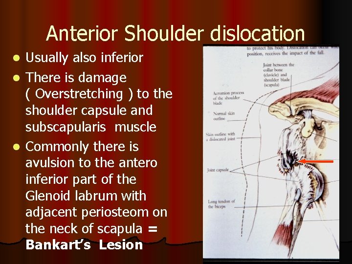 Anterior Shoulder dislocation Usually also inferior l There is damage ( Overstretching ) to