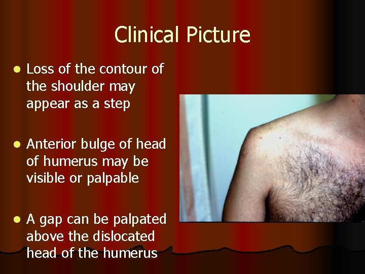 Clinical Picture l Loss of the contour of the shoulder may appear as a