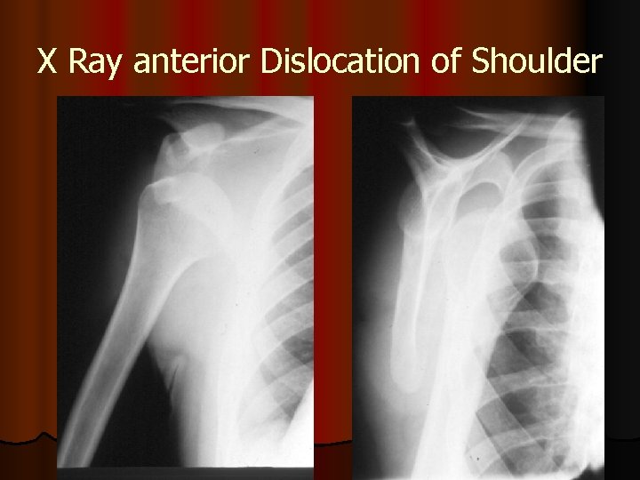 X Ray anterior Dislocation of Shoulder 
