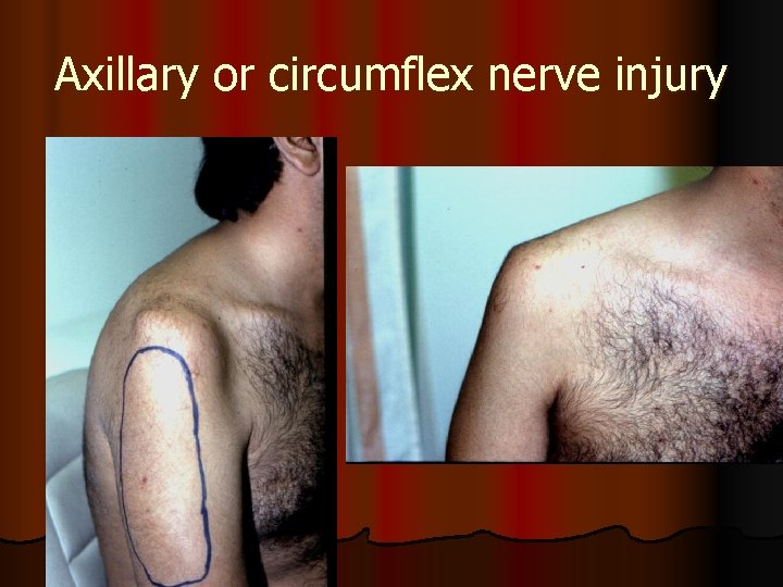 Axillary or circumflex nerve injury 