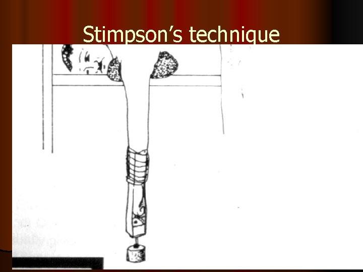 Stimpson’s technique 