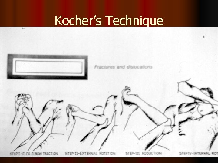 Kocher’s Technique 