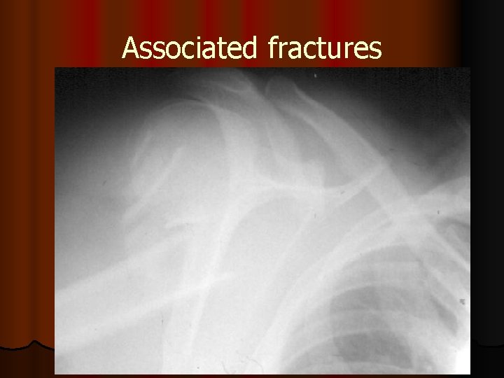 Associated fractures 