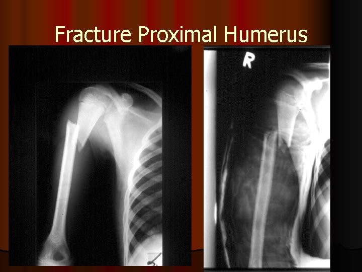 Fracture Proximal Humerus 