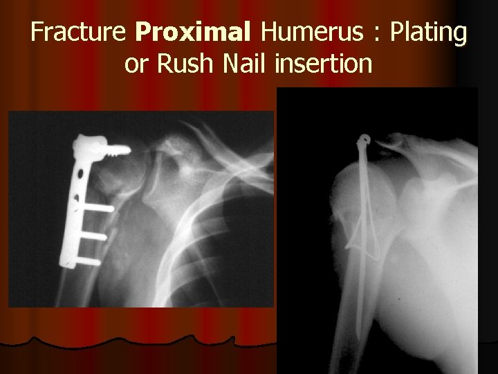 Fracture Proximal Humerus : Plating or Rush Nail insertion 