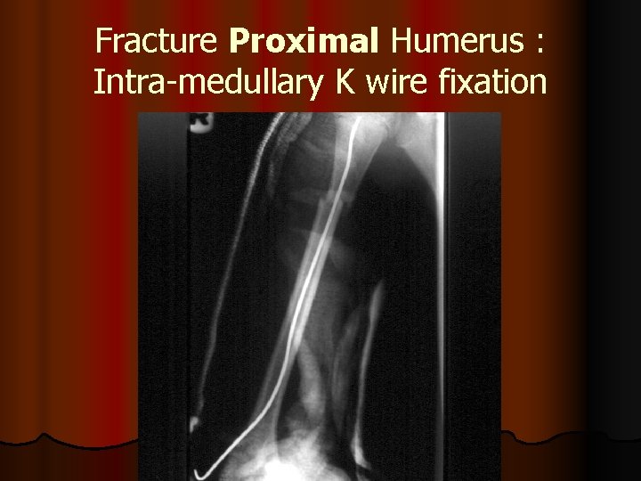 Fracture Proximal Humerus : Intra-medullary K wire fixation 