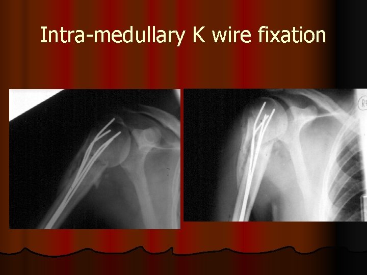 Intra-medullary K wire fixation 