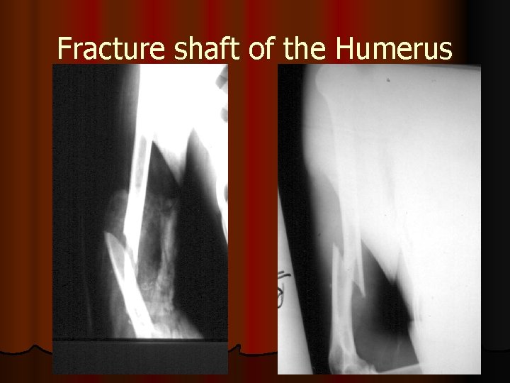 Fracture shaft of the Humerus 