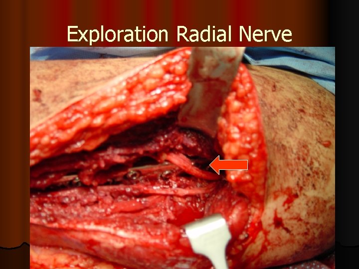 Exploration Radial Nerve 