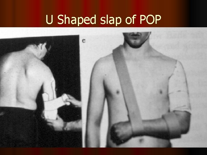 U Shaped slap of POP 