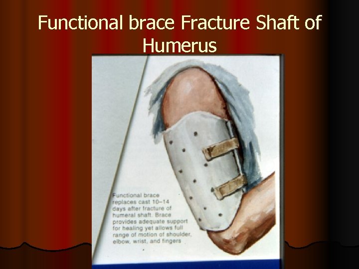 Functional brace Fracture Shaft of Humerus 