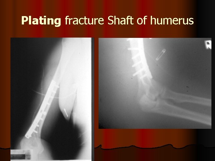 Plating fracture Shaft of humerus 