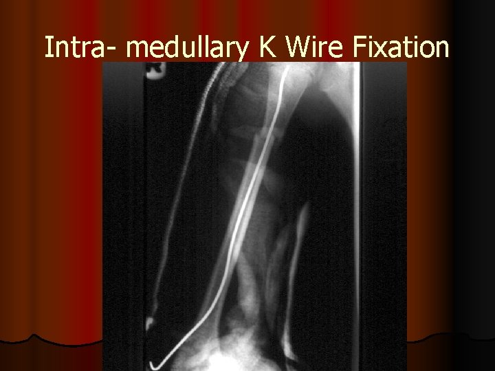 Intra- medullary K Wire Fixation 