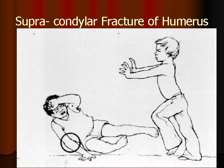 Supra- condylar Fracture of Humerus 