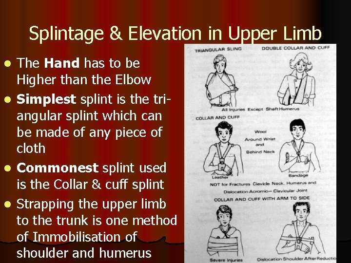 Splintage & Elevation in Upper Limb The Hand has to be Higher than the