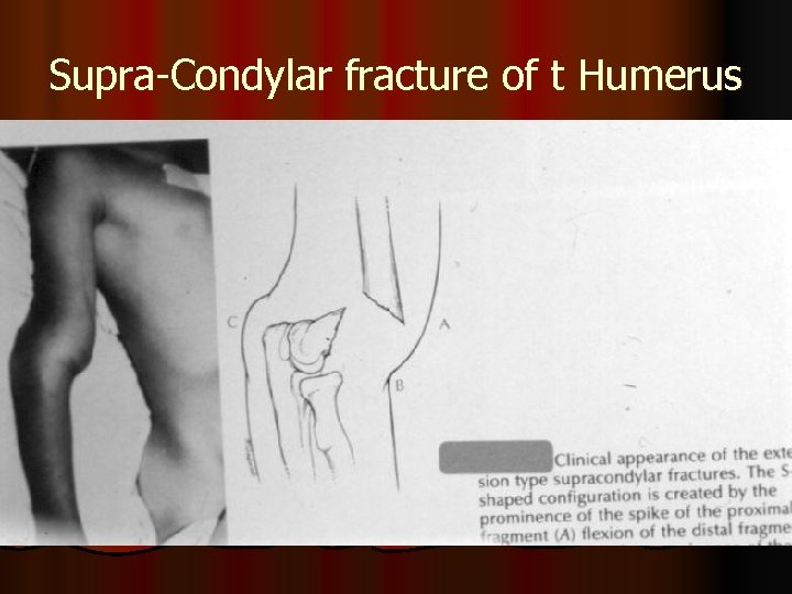 Supra-Condylar fracture of t Humerus 