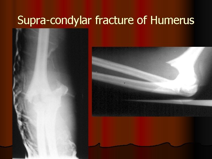 Supra-condylar fracture of Humerus 