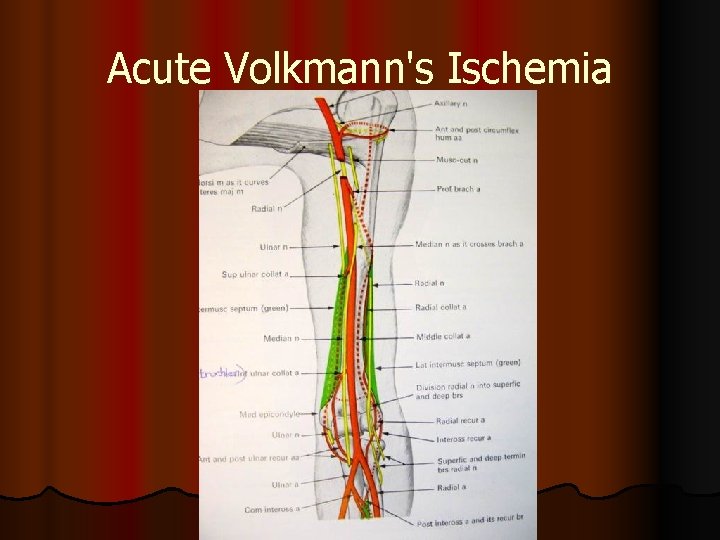 Acute Volkmann's Ischemia 