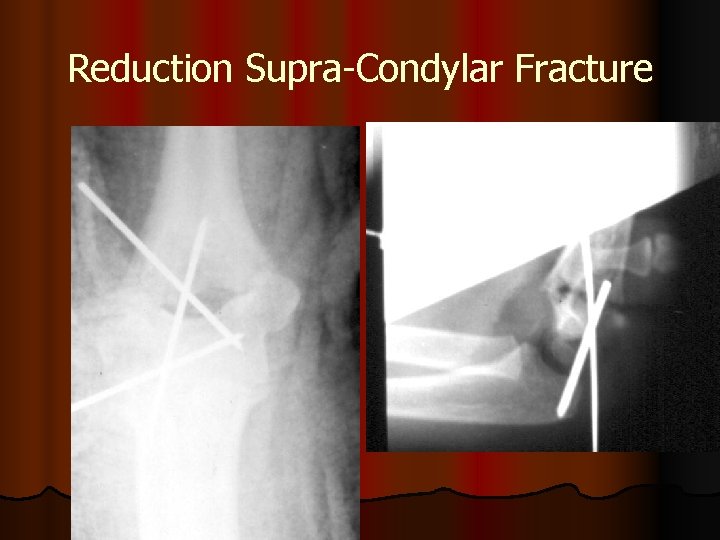 Reduction Supra-Condylar Fracture 