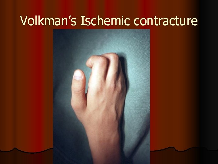 Volkman’s Ischemic contracture 
