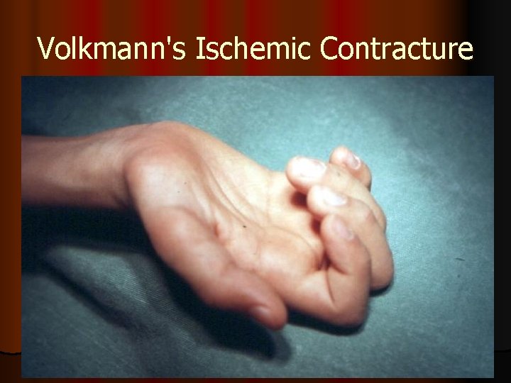 Volkmann's Ischemic Contracture 