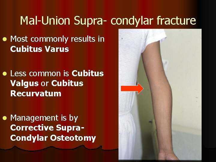 Mal-Union Supra- condylar fracture l Most commonly results in Cubitus Varus l Less common