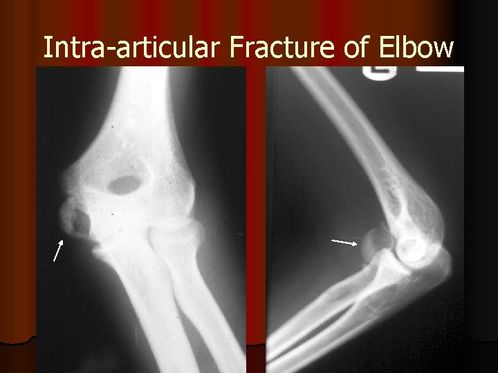 Intra-articular Fracture of Elbow 
