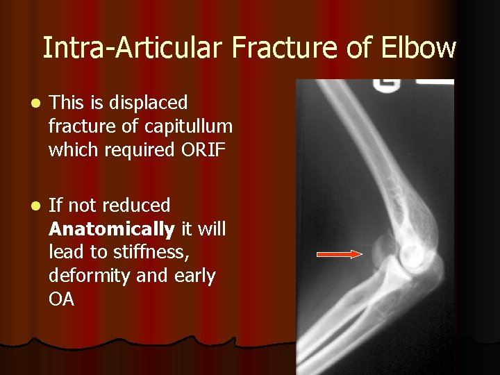 Intra-Articular Fracture of Elbow l This is displaced fracture of capitullum which required ORIF