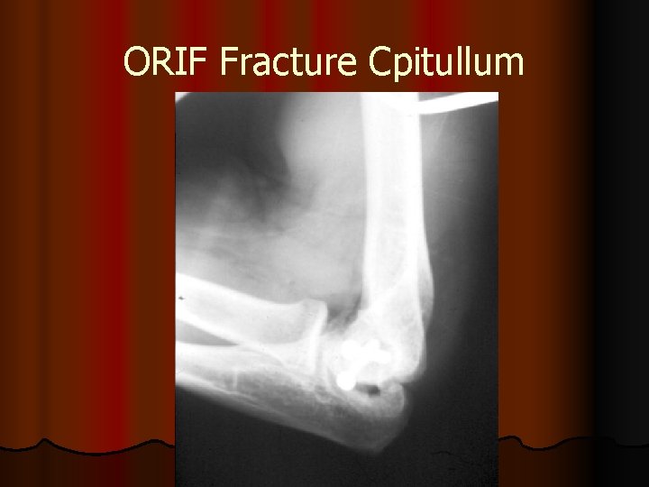 ORIF Fracture Cpitullum 