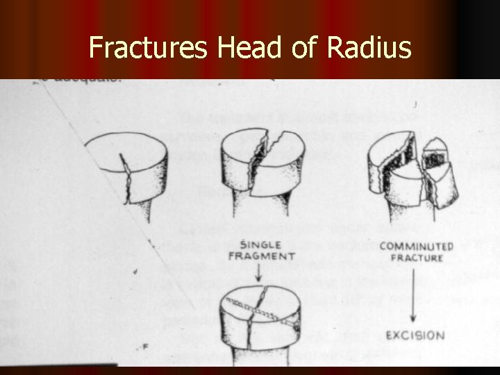 Fractures Head of Radius 