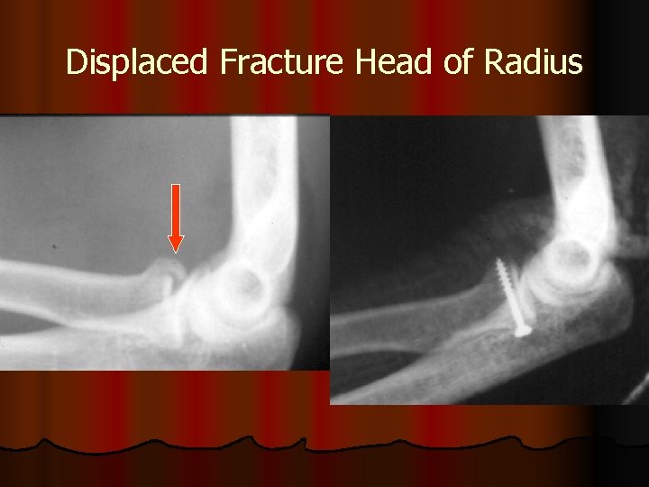 Displaced Fracture Head of Radius 