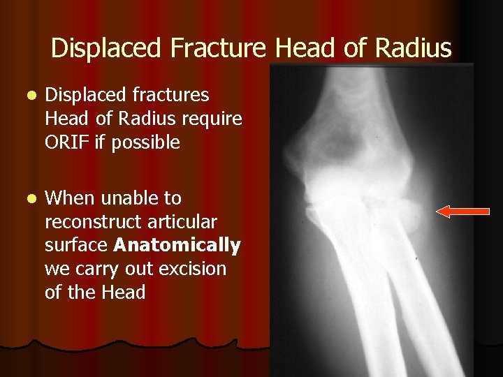 Displaced Fracture Head of Radius l Displaced fractures Head of Radius require ORIF if