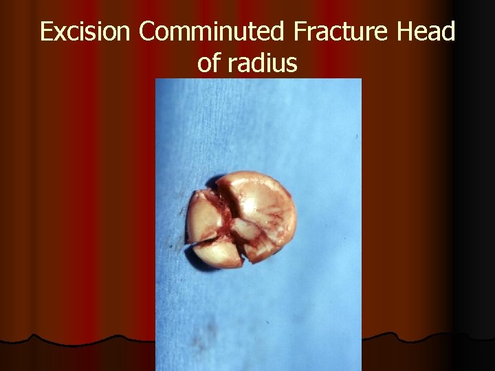 Excision Comminuted Fracture Head of radius 