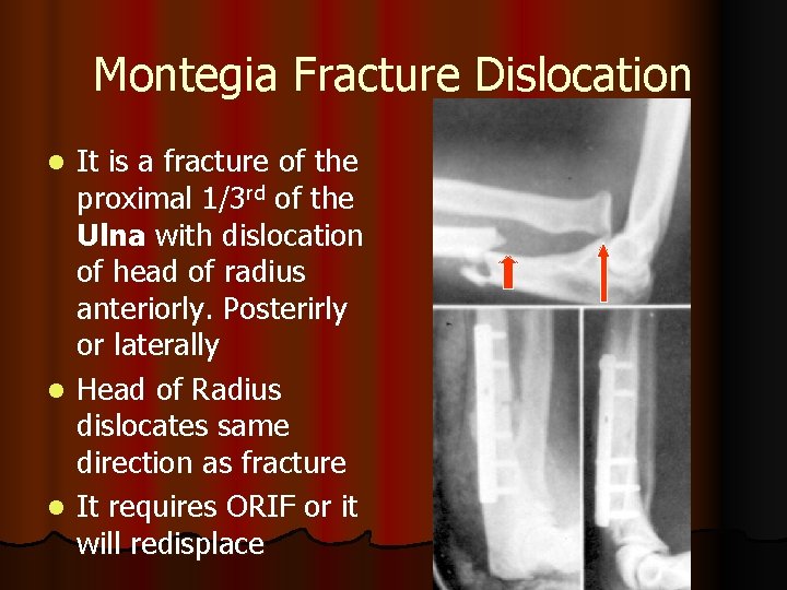 Montegia Fracture Dislocation It is a fracture of the proximal 1/3 rd of the