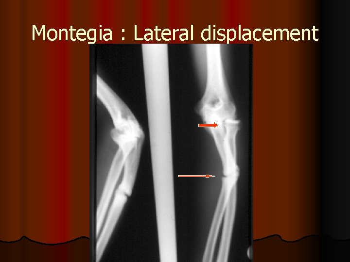 Montegia : Lateral displacement 