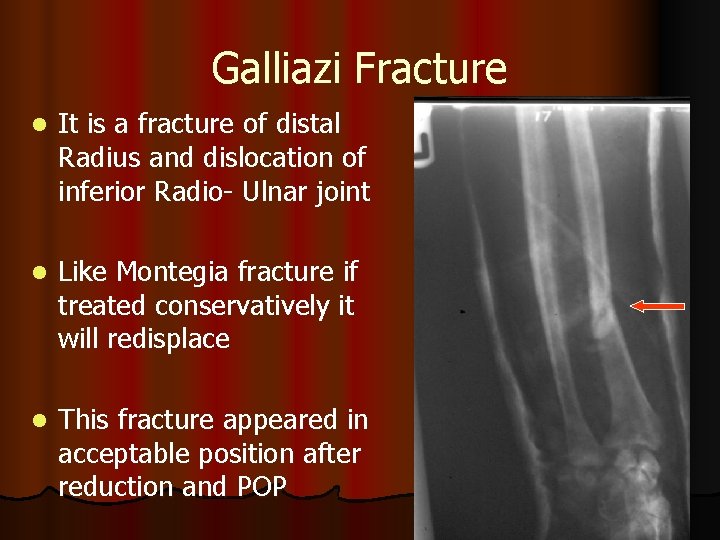 Galliazi Fracture l It is a fracture of distal Radius and dislocation of inferior