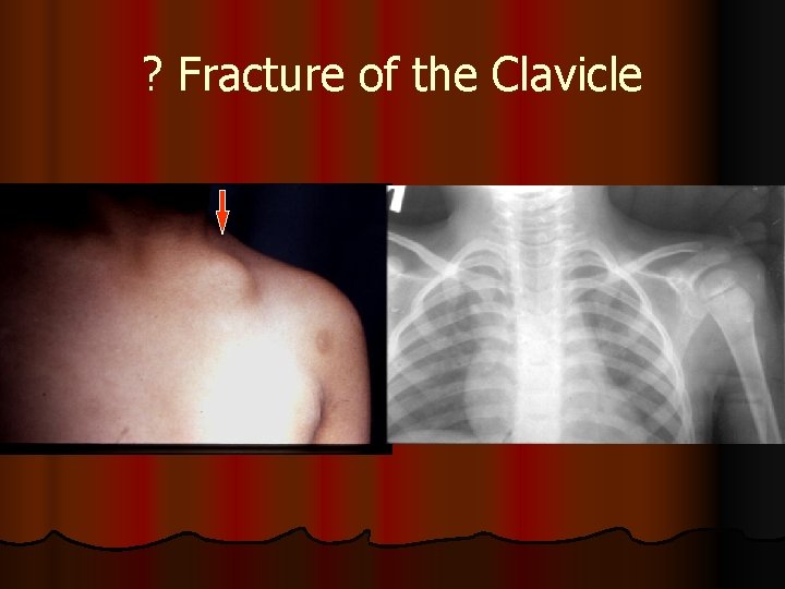 ? Fracture of the Clavicle 