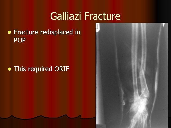 Galliazi Fracture l Fracture redisplaced in POP l This required ORIF 