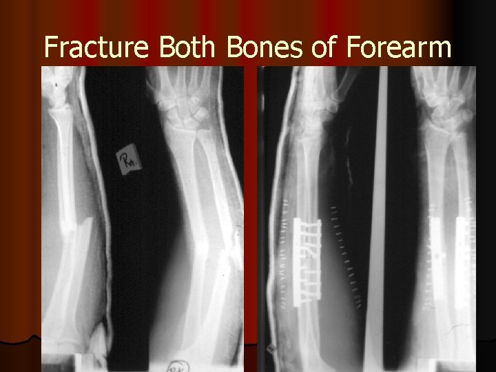 Fracture Both Bones of Forearm 
